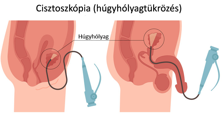Húgyhólyagtükrözés