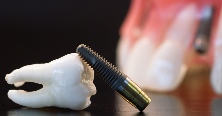 Fogászati implantátum