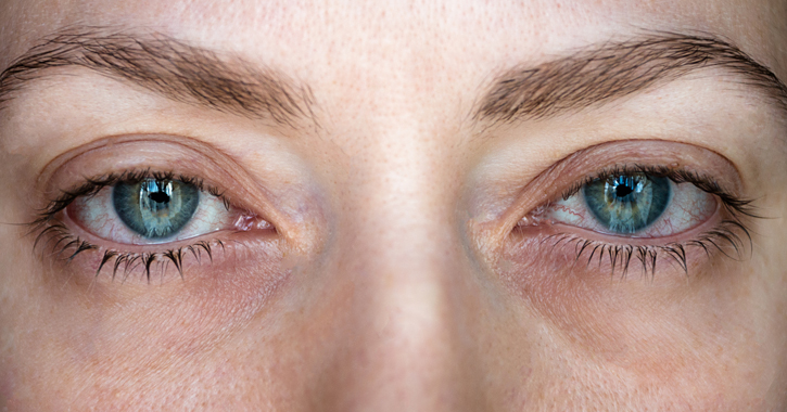 Sarcoidosis