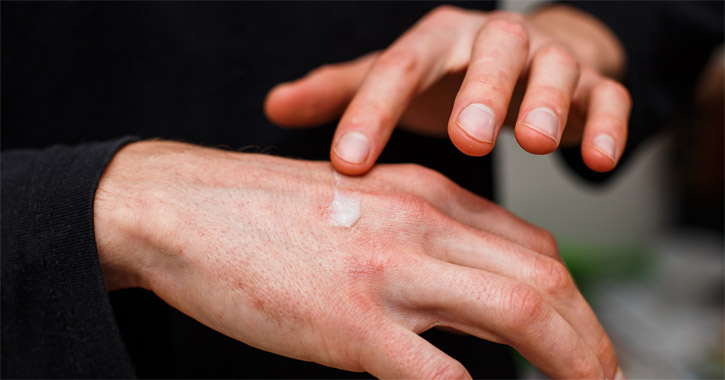 Kontakt dermatitis