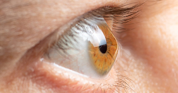 Keratoconus - A szaruhártya deformációja