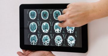 Stroke, agyérgörcs, agyvérzés - Mi a különbség?