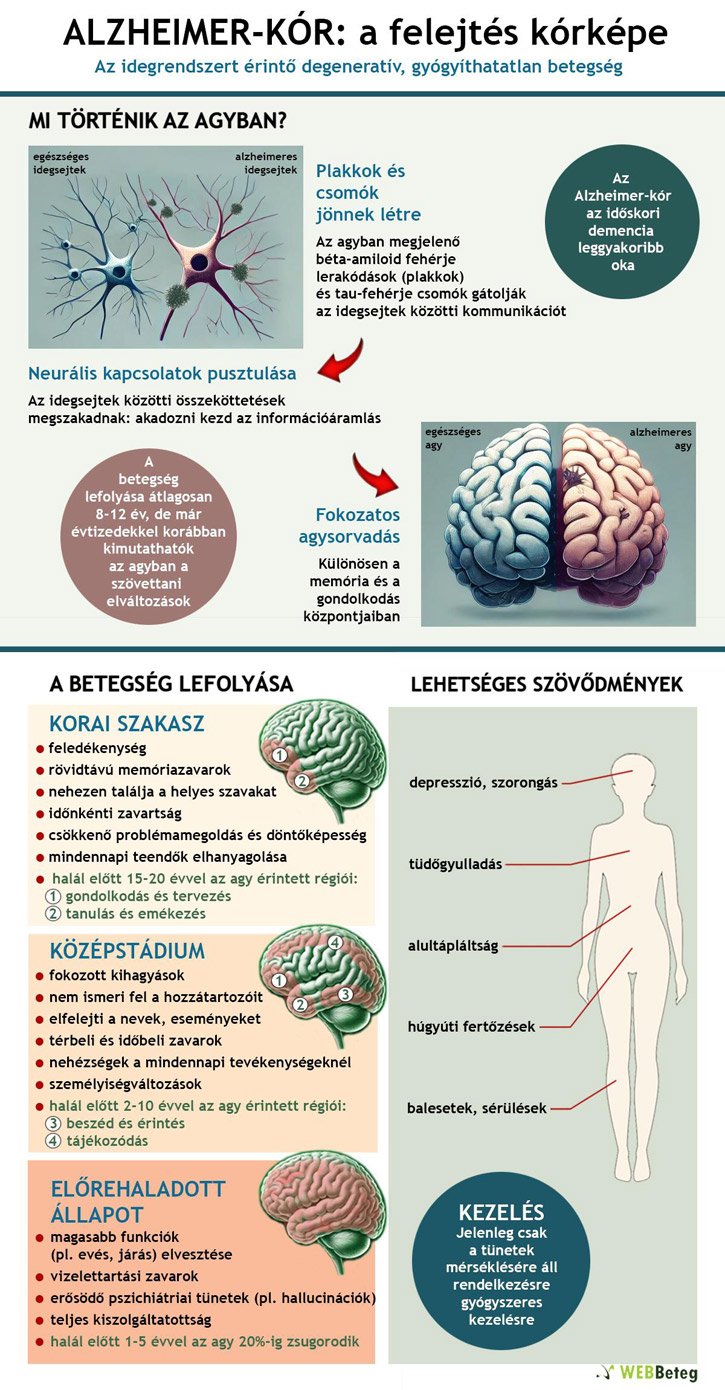 Alzheimer-kór infografika