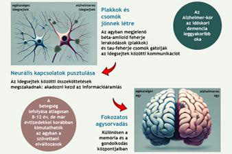 Az Alzheimer-kór jelenleg nem gyógyítható