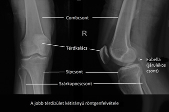 Röntgenfelvételekkel a térdízület csontos alkotói vizsgálhatók