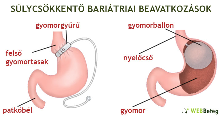 Bariátriai beavatkozások: gyomorballon és gyomorgyűrű