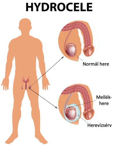 Herevízsérv (hydrocele) ábra