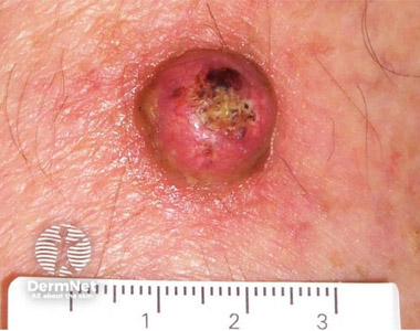 Keratoacanthoma