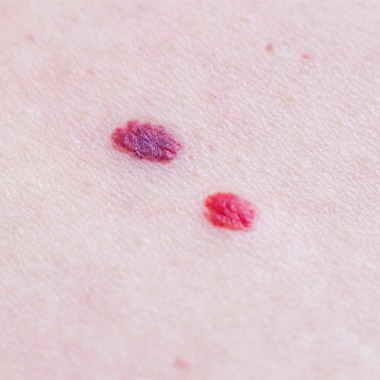 Hemangioma