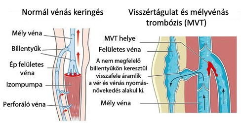 Mélyvénás trombózis és visszértágulat