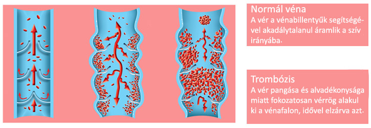 Mélyvénás trombózis ábra