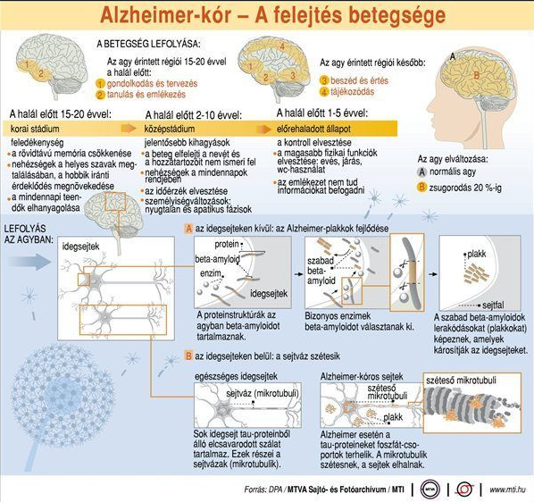 Alzheimer infografika